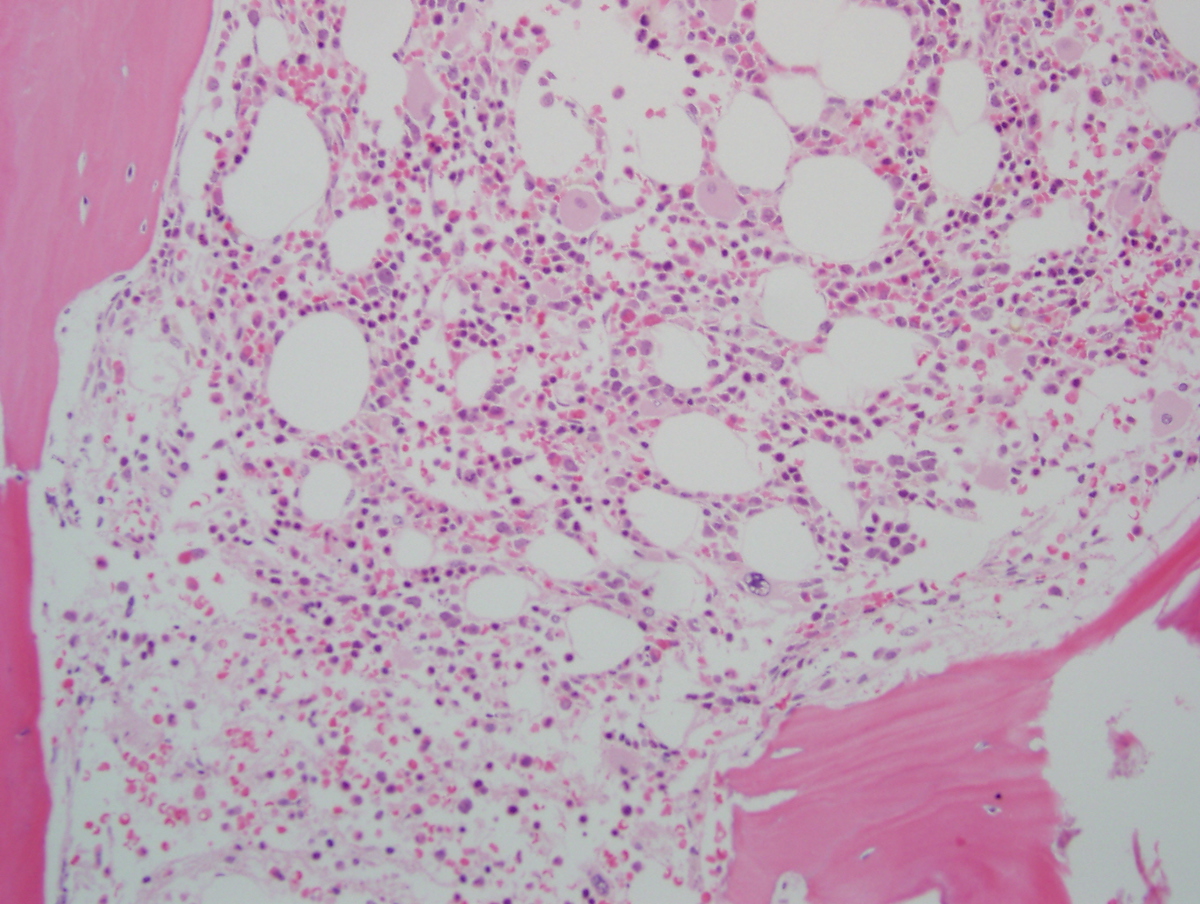 Bone marrow Biopsy March 2006
